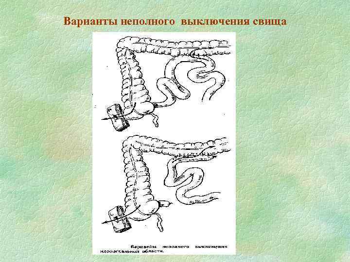 Варианты неполного выключения свища 