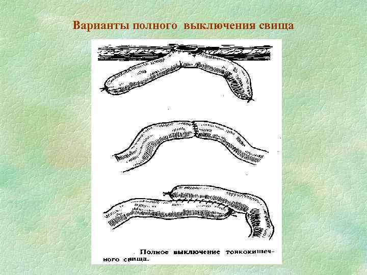 Варианты полного выключения свища 