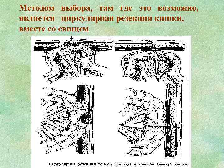 Методом выбора, там где это возможно, является циркулярная резекция кишки, вместе со свищем 