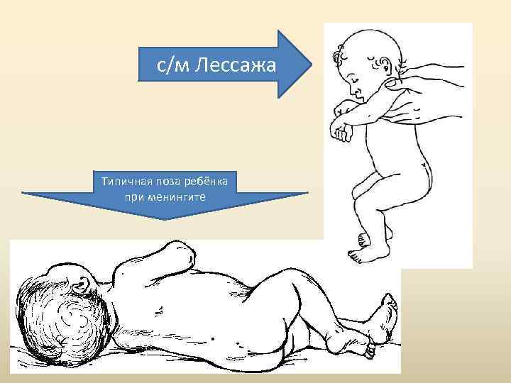с/м Лессажа Типичная поза ребёнка при менингите 
