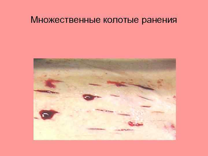 Множественные колотые ранения 