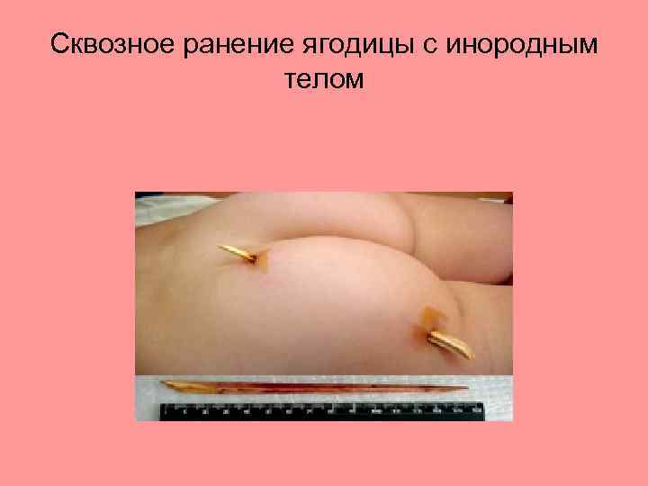 Сквозное ранение ягодицы с инородным телом 