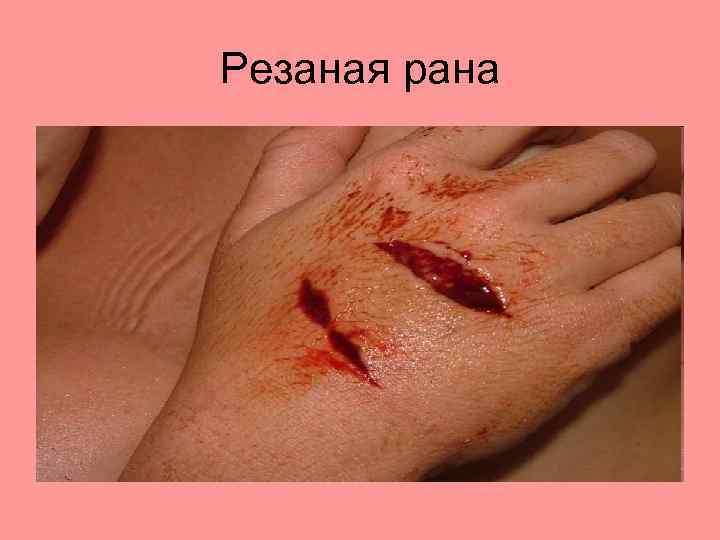 Резаная рана 