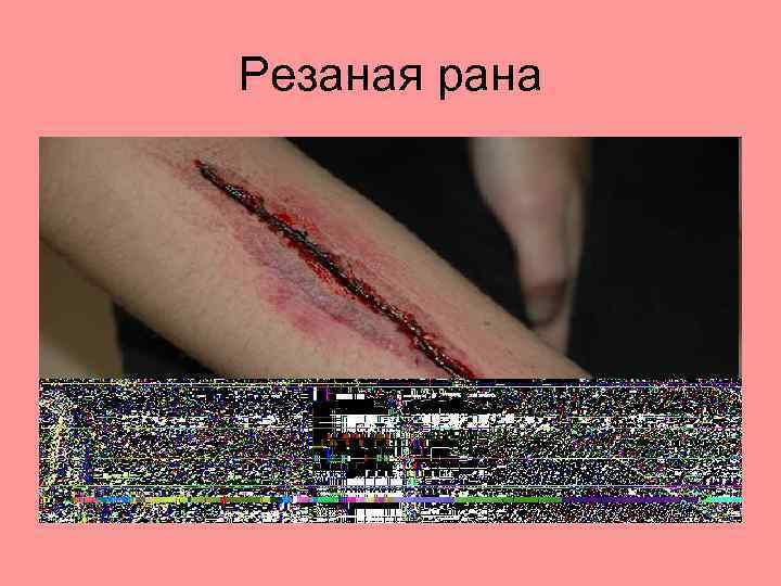 Резаная рана 