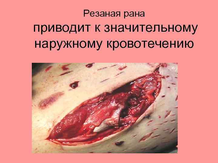 Резаная рана приводит к значительному наружному кровотечению 