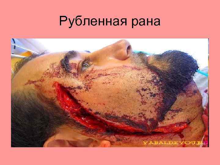 Рубленная рана 