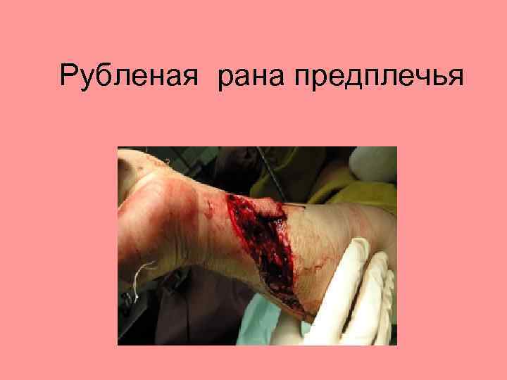 Рубленая рана предплечья 