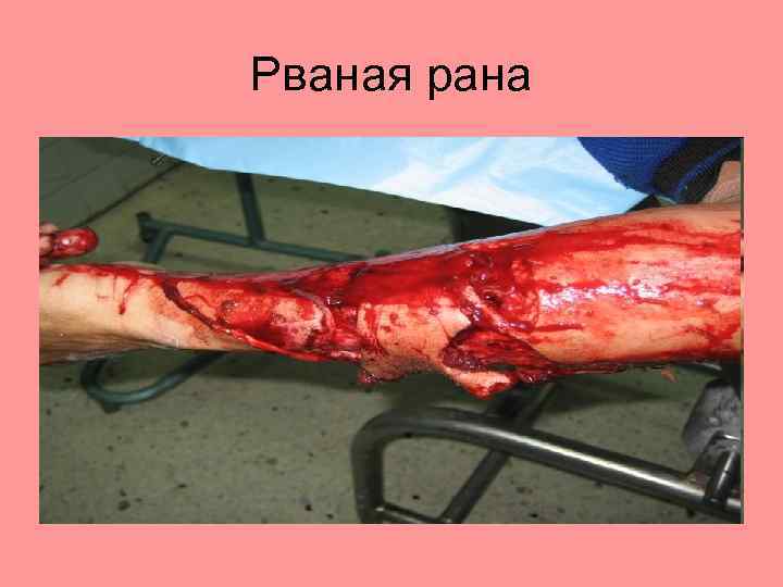 Рваная рана 