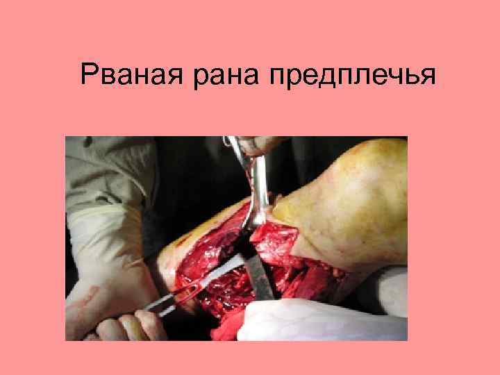 Рваная рана предплечья 