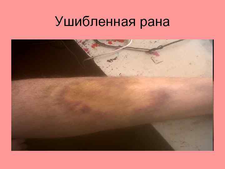 Ушибленная рана 