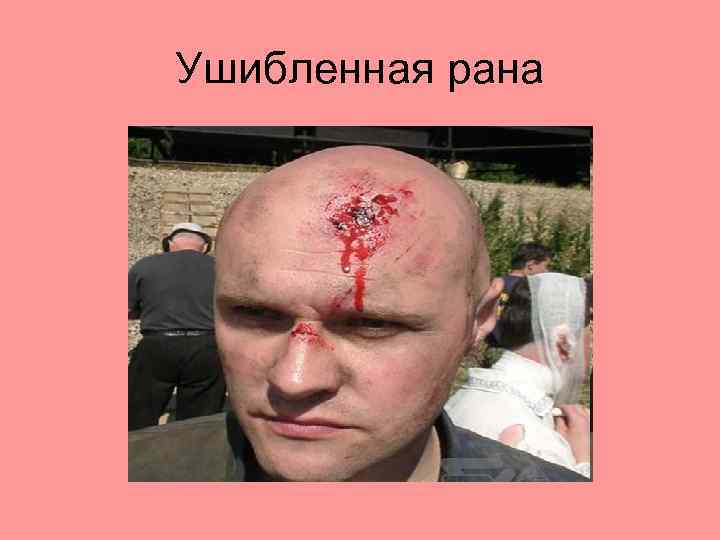 Ушибленная рана 