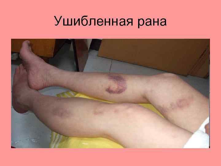 Ушибленная рана 