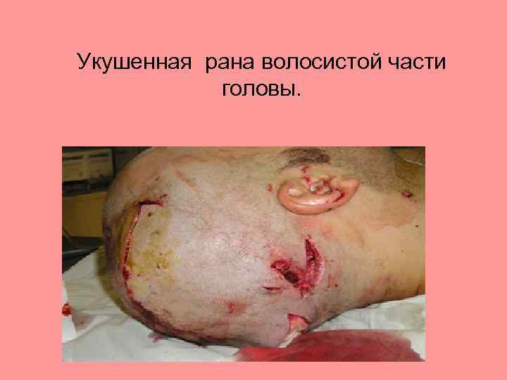 Укушенная рана волосистой части головы. 