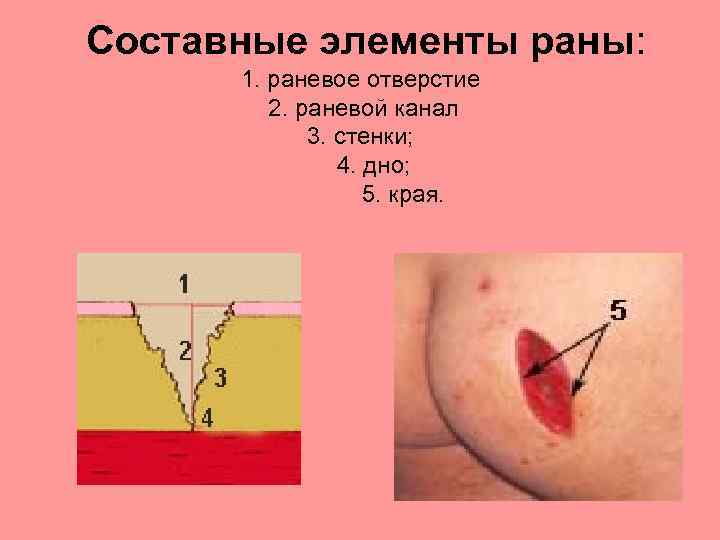  Составные элементы раны: 1. раневое отверстие 2. раневой канал 3. стенки; 4. дно;