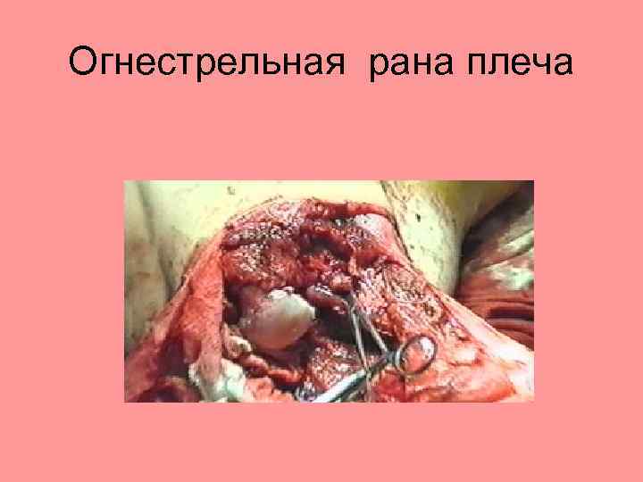 Огнестрельная рана плеча 