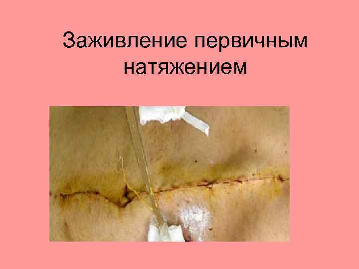Заживление первичным натяжением 