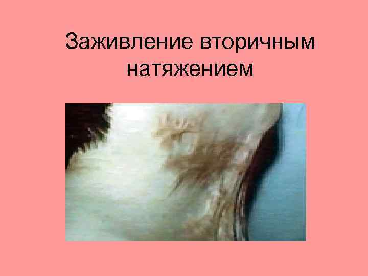 Заживление вторичным натяжением 