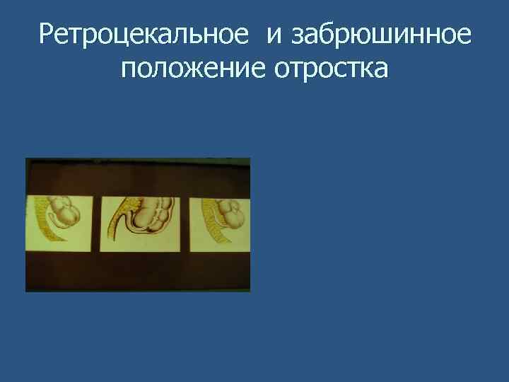 Ретроцекальное и забрюшинное положение отростка 