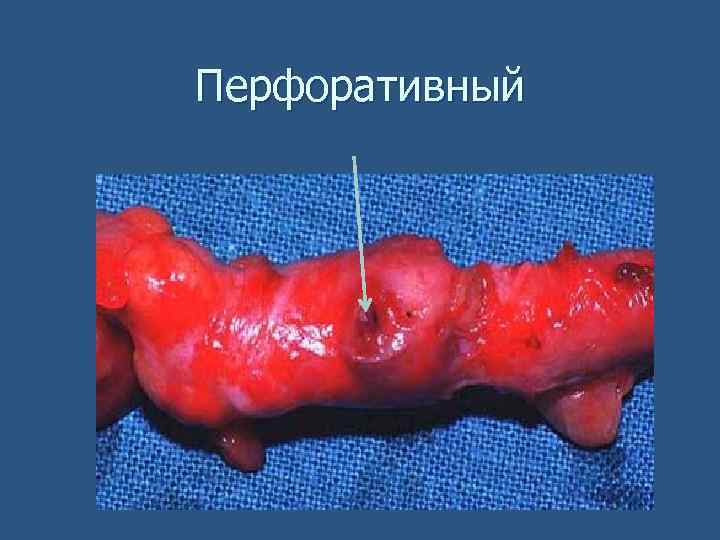 Перфоративный 