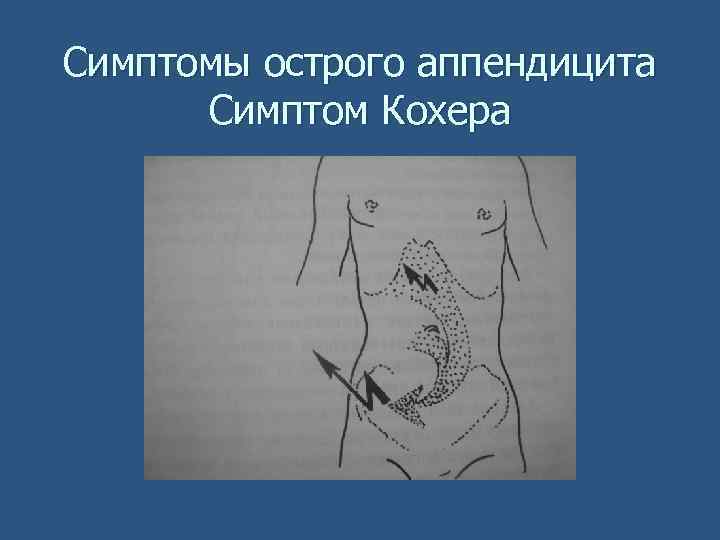 Симптомы острого аппендицита Симптом Кохера 