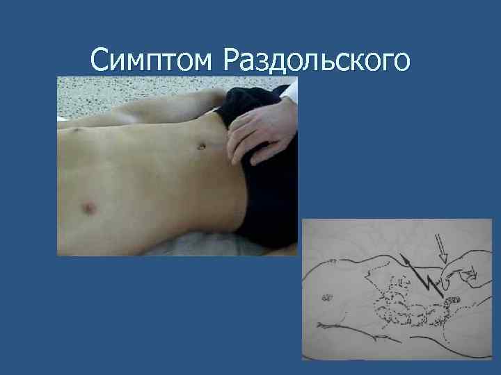 Симптом Раздольского 