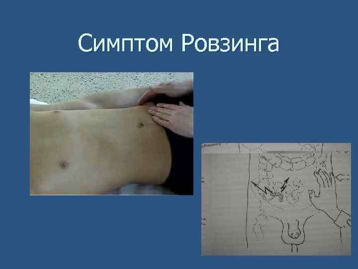 Симптом Ровзинга 