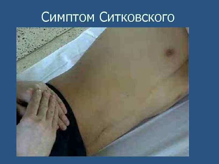 Симптом Ситковского 