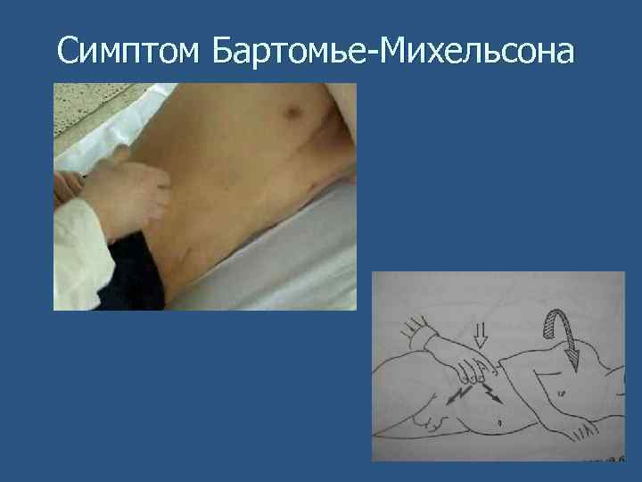 Симптом Бартомье-Михельсона 