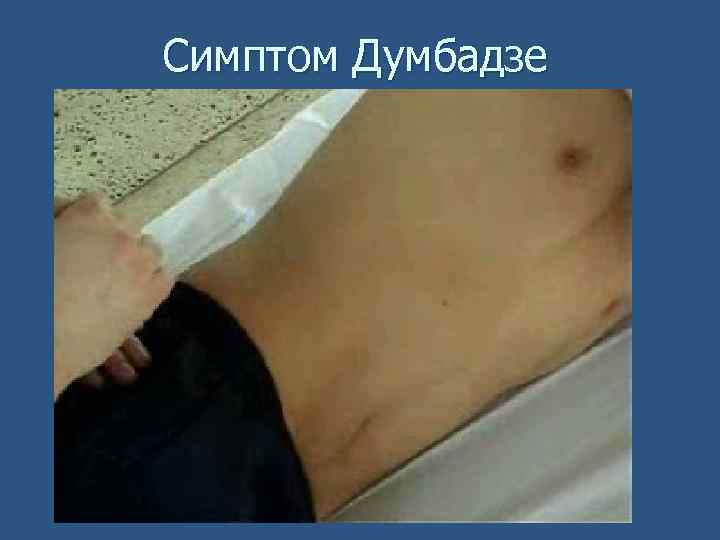 Симптом Думбадзе 