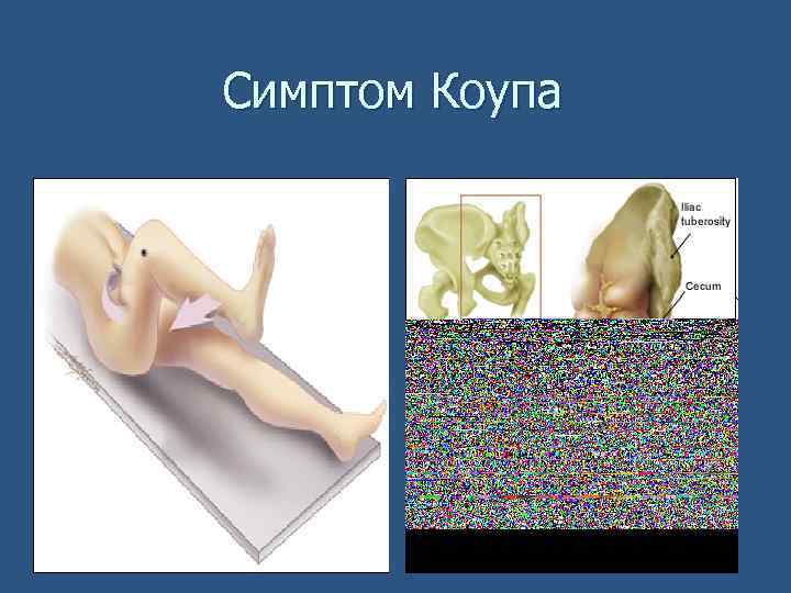 Симптом Коупа 