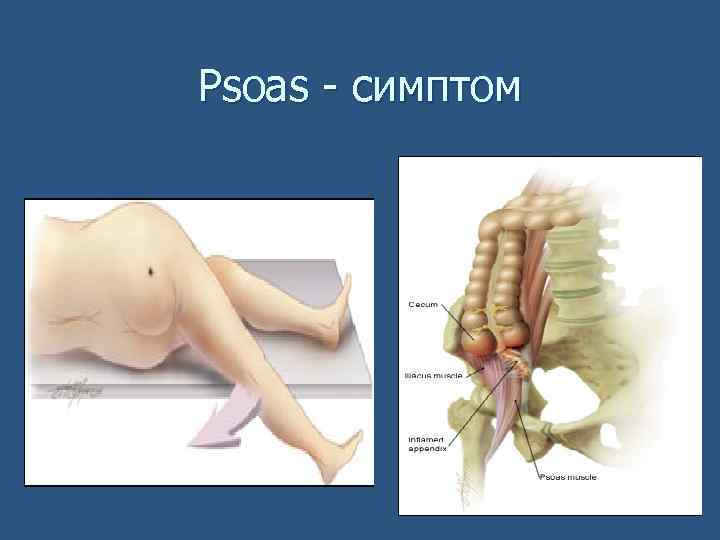 Psoas - симптом 