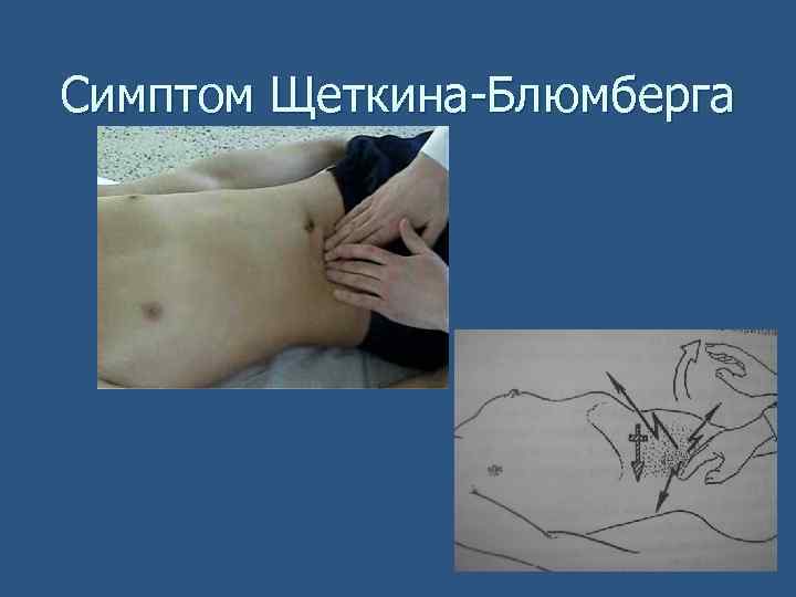 Симптом Щеткина-Блюмберга 