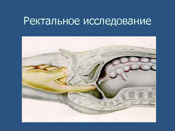 Ректальное исследование 
