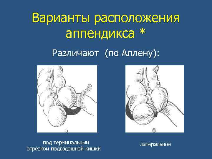 Варианты расположения аппендикса * Различают (по Аллену): под терминальным отрезком подвздошной кишки латеральное 