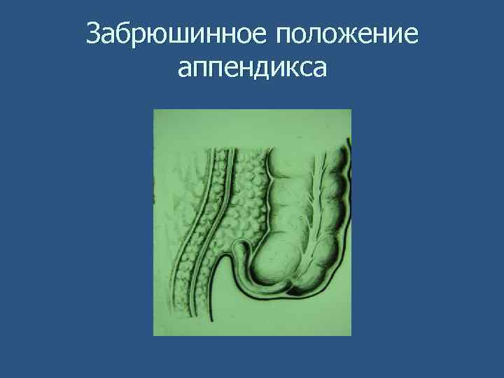 Забрюшинное положение аппендикса 