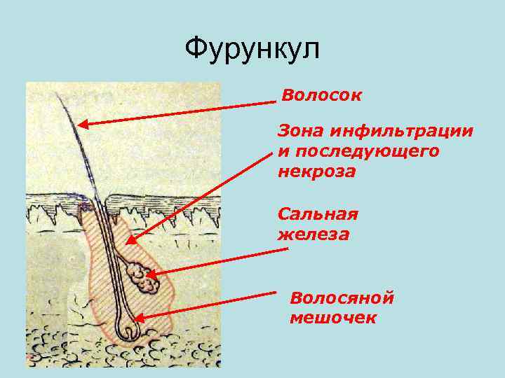 Фурункул Волосок Зона инфильтрации и последующего некроза Сальная железа Волосяной мешочек 
