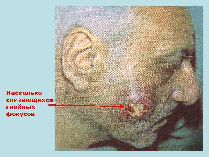 Несколько сливающихся гнойных фокусов 