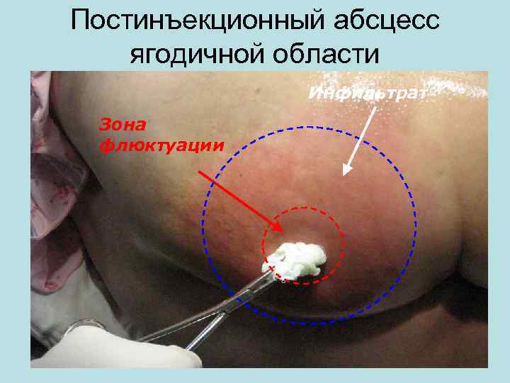 Постинъекционный абсцесс ягодичной области Инфильтрат Зона флюктуации 