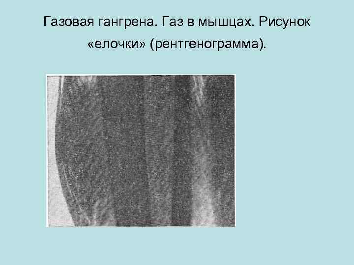 Газовая гангрена. Газ в мышцах. Рисунок «елочки» (рентгенограмма). 