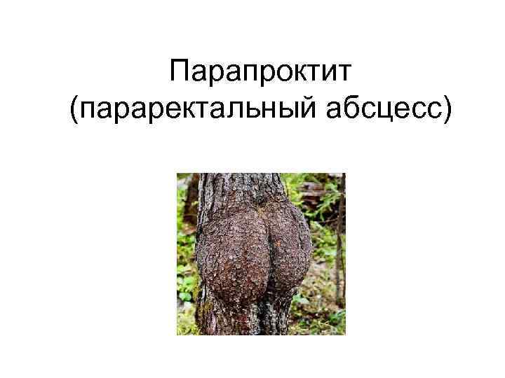 Парапроктит (параректальный абсцесс) 