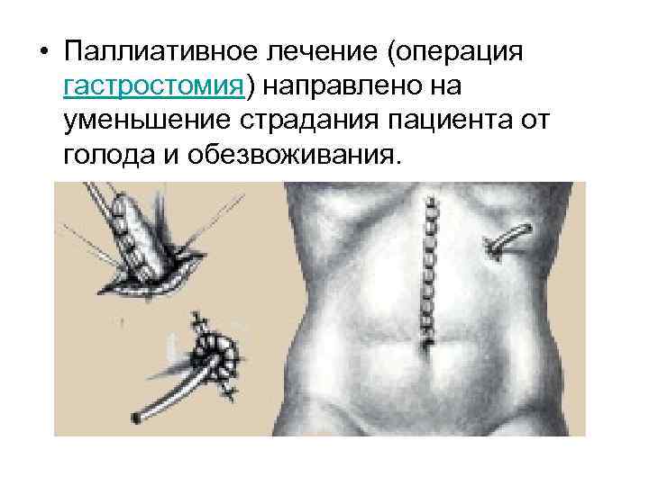  • Паллиативное лечение (операция гастростомия) направлено на уменьшение страдания пациента от голода и
