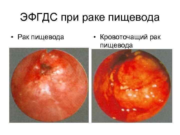 ЭФГДС при раке пищевода • Рак пищевода • Кровоточащий рак пищевода 