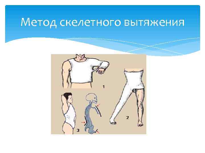 Метод скелетного вытяжения 