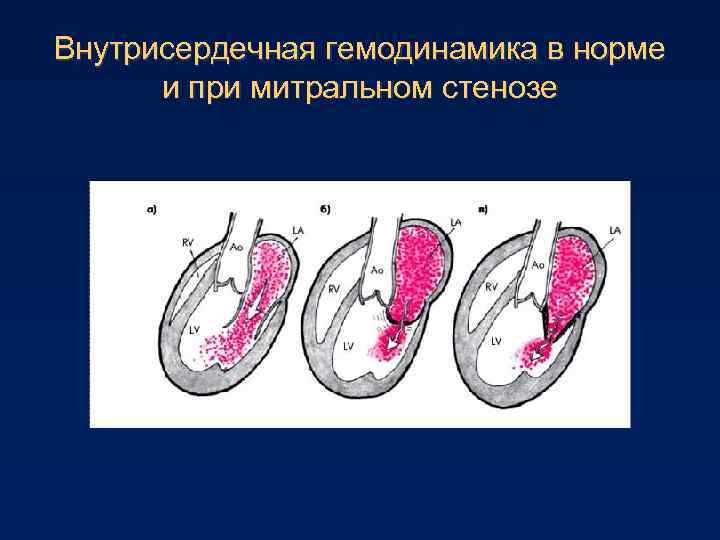 Гемодинамика митральный стеноз схема