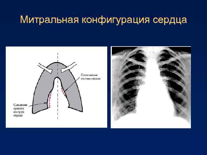 Митральная конфигурация сердца 