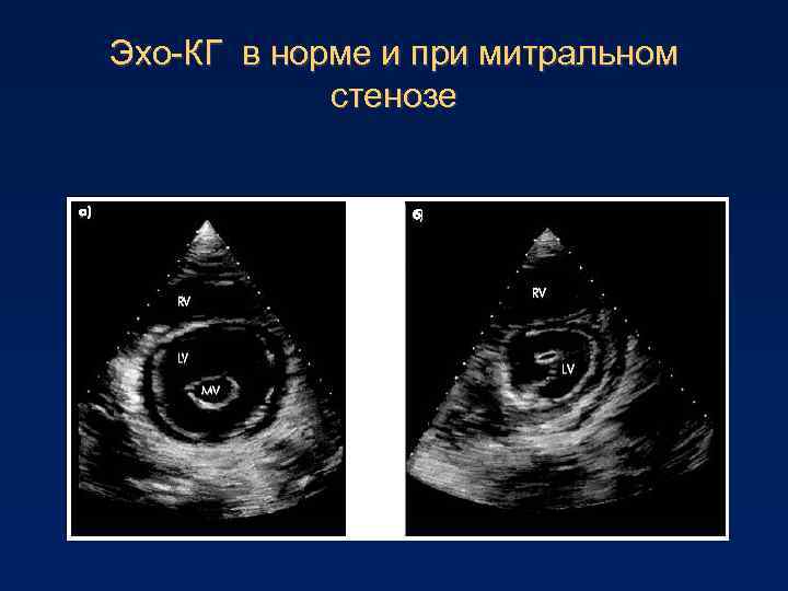 Эхо-КГ в норме и при митральном стенозе 