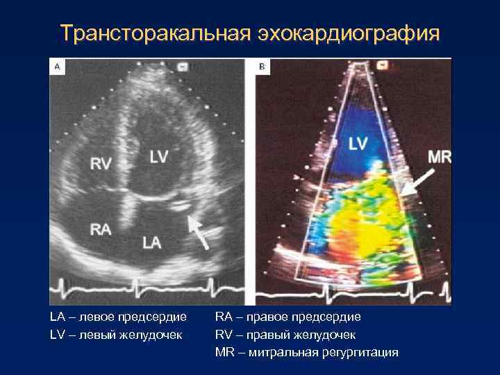 Трансторакальная эхокардиография LA – левое предсердие LV – левый желудочек RA – правое предсердие