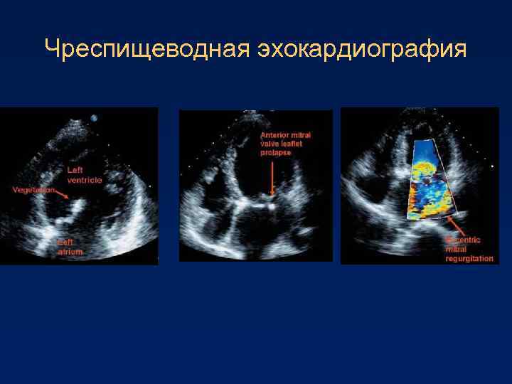 Чреспищеводная эхокардиография 