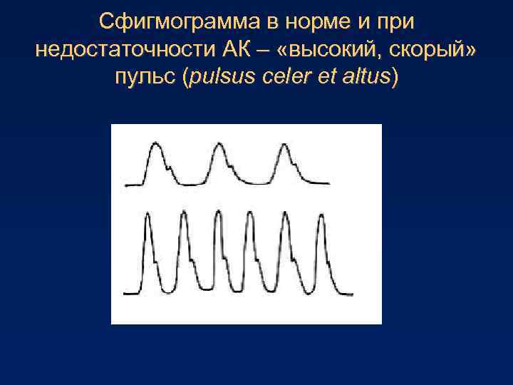 Сфигмограмма в норме и при недостаточности АК – «высокий, скорый» пульс (pulsus celer et