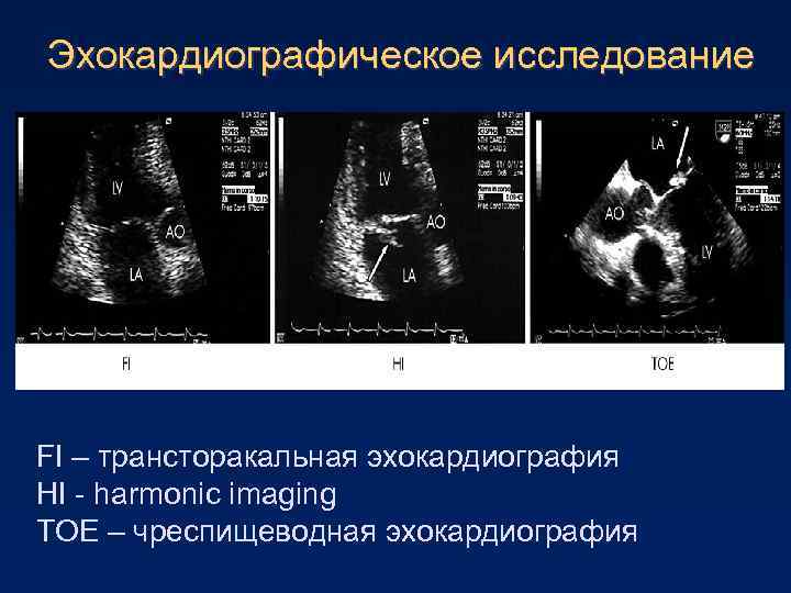 Эхокардиографическое исследование FI – трансторакальная эхокардиография HI - harmonic imaging TOE – чреспищеводная эхокардиография